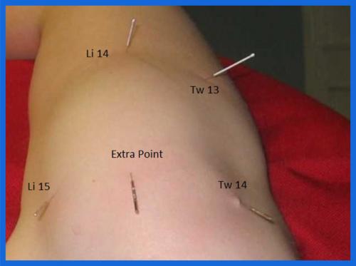 student_pic_0004_shoulder_joint_acupuncture