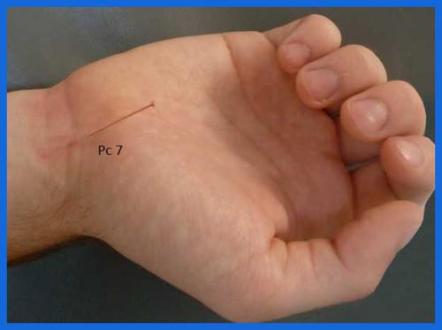 student_pic_0006_pericardium7_acupuncture