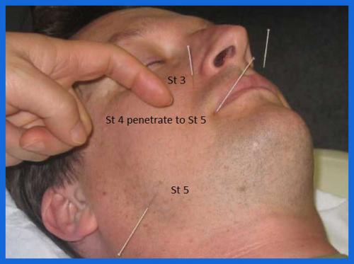 student_pic_0020_facial_acupuncture_session