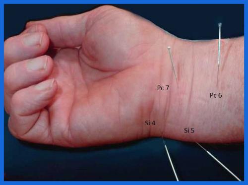student_pic_0034_acupuncture_wrist