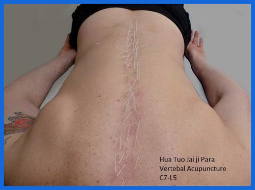 student_pic_0040_acupuncture_spinal