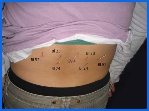 student_pic_0043_acupuncture_lower_back_pain