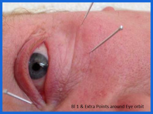 student_pic_0048_acupuncture_eye