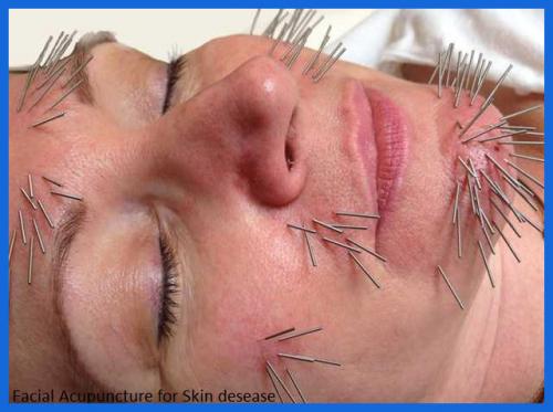 student_pic_0049_acupuncture_cosmetic_face