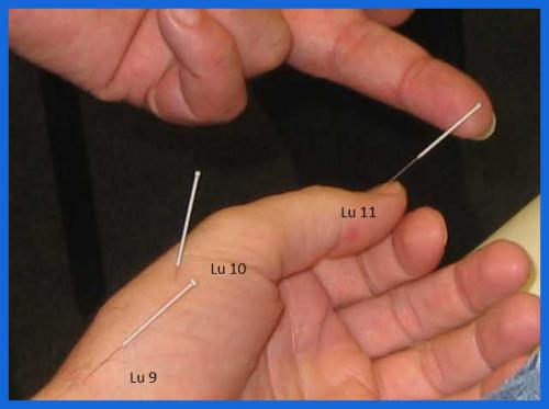 student_pic_0055_acupucnture_treatment